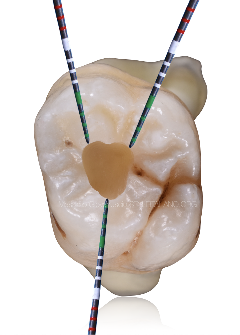 Post endodontic restoration of Class I cavities