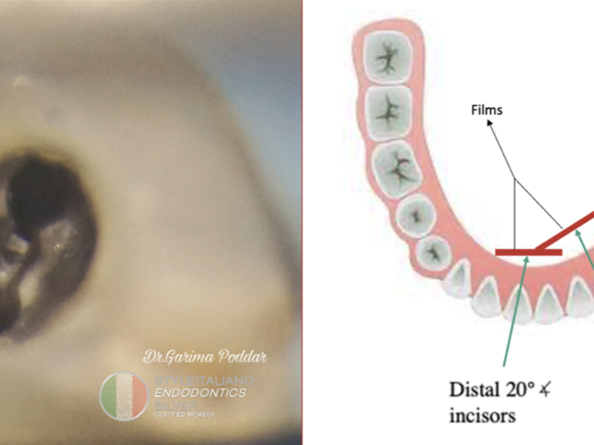 The importance of the tube shift technique of radiography, during