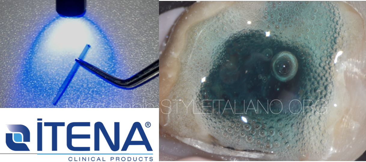 Root To Crown With Dentoclic Fiber Post Build Up Chapter 1: Molar Case