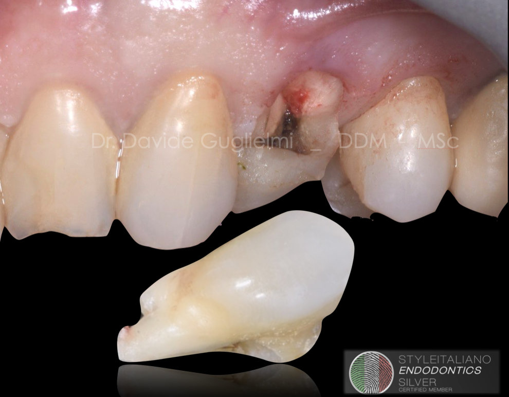 Treatment of an extensive radicular fracture: the pre-endodontic restoration of a structurally compromised tooth. Part 1