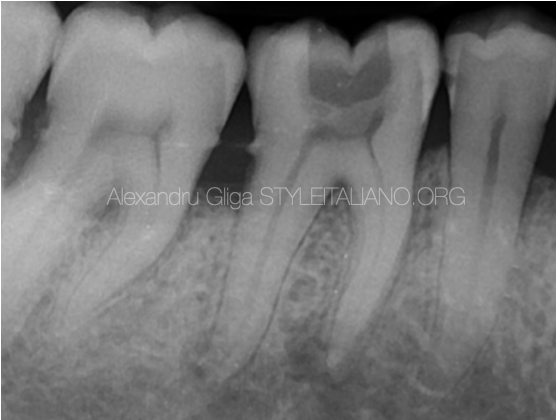 Primary Root Canal Treatment of LR6 using the MG3 Blue system from Perfect: A case report