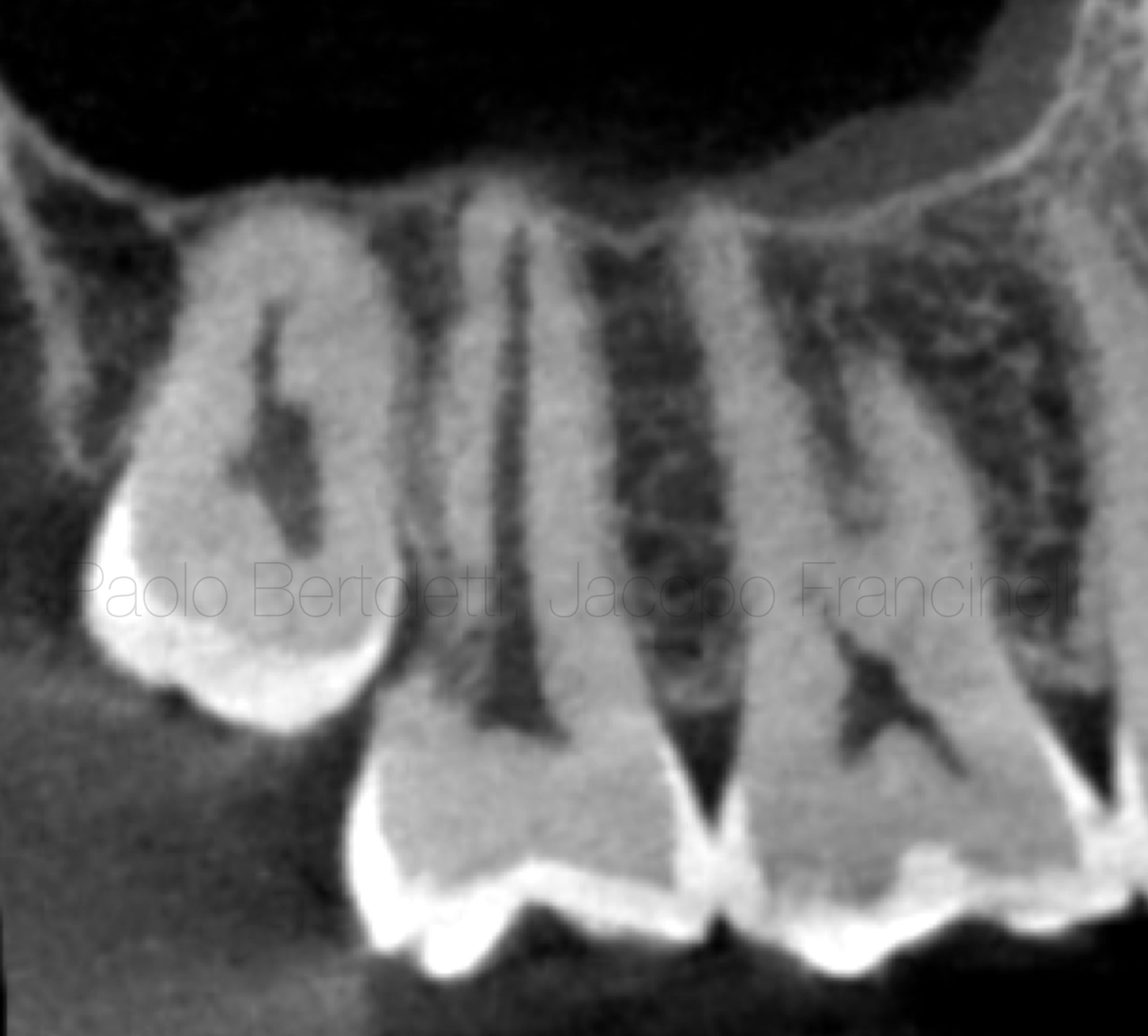 External root resorption: is intentional replantation a real option? A case report