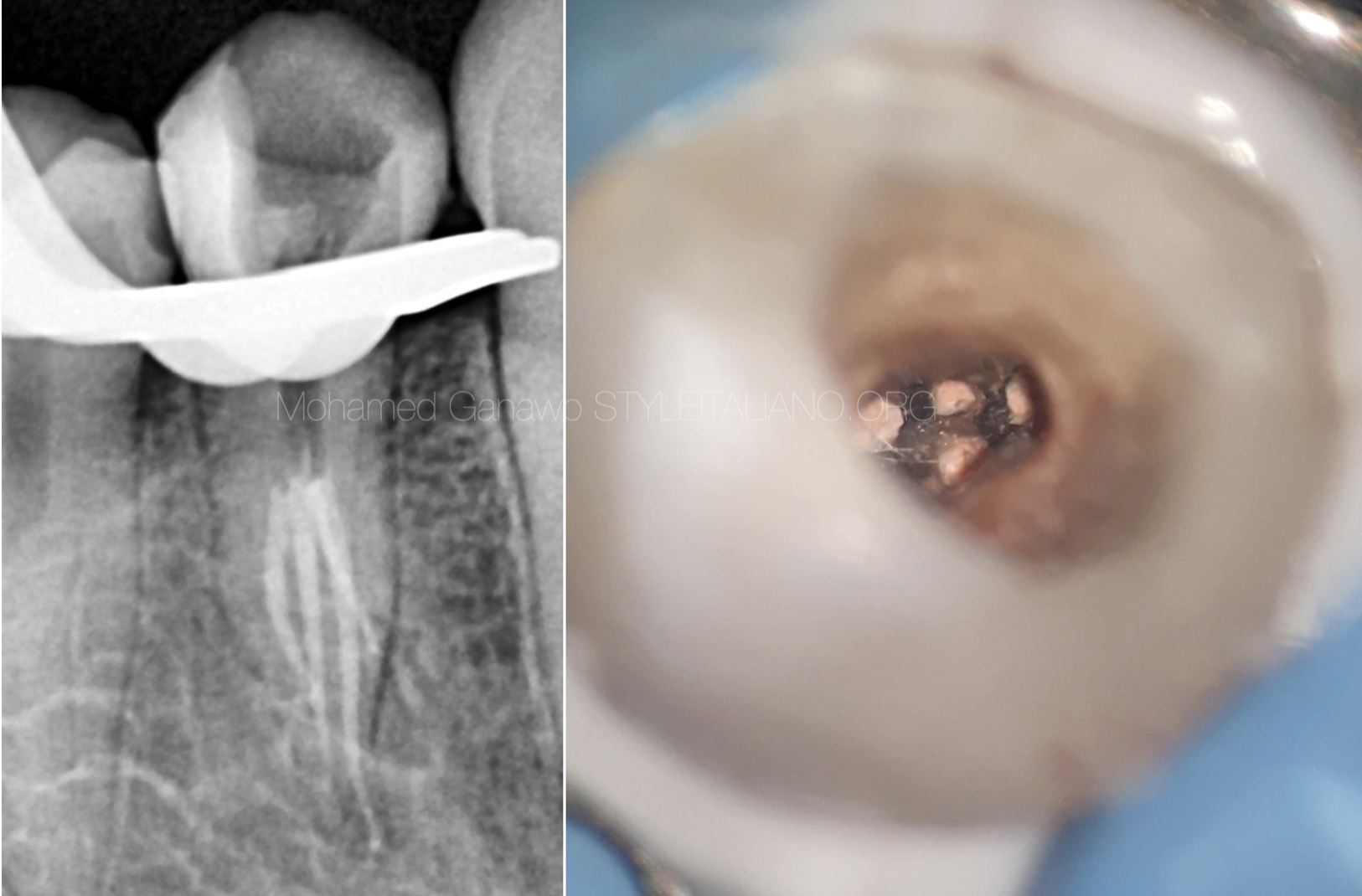 Management of a mandibular first premolar with four canals