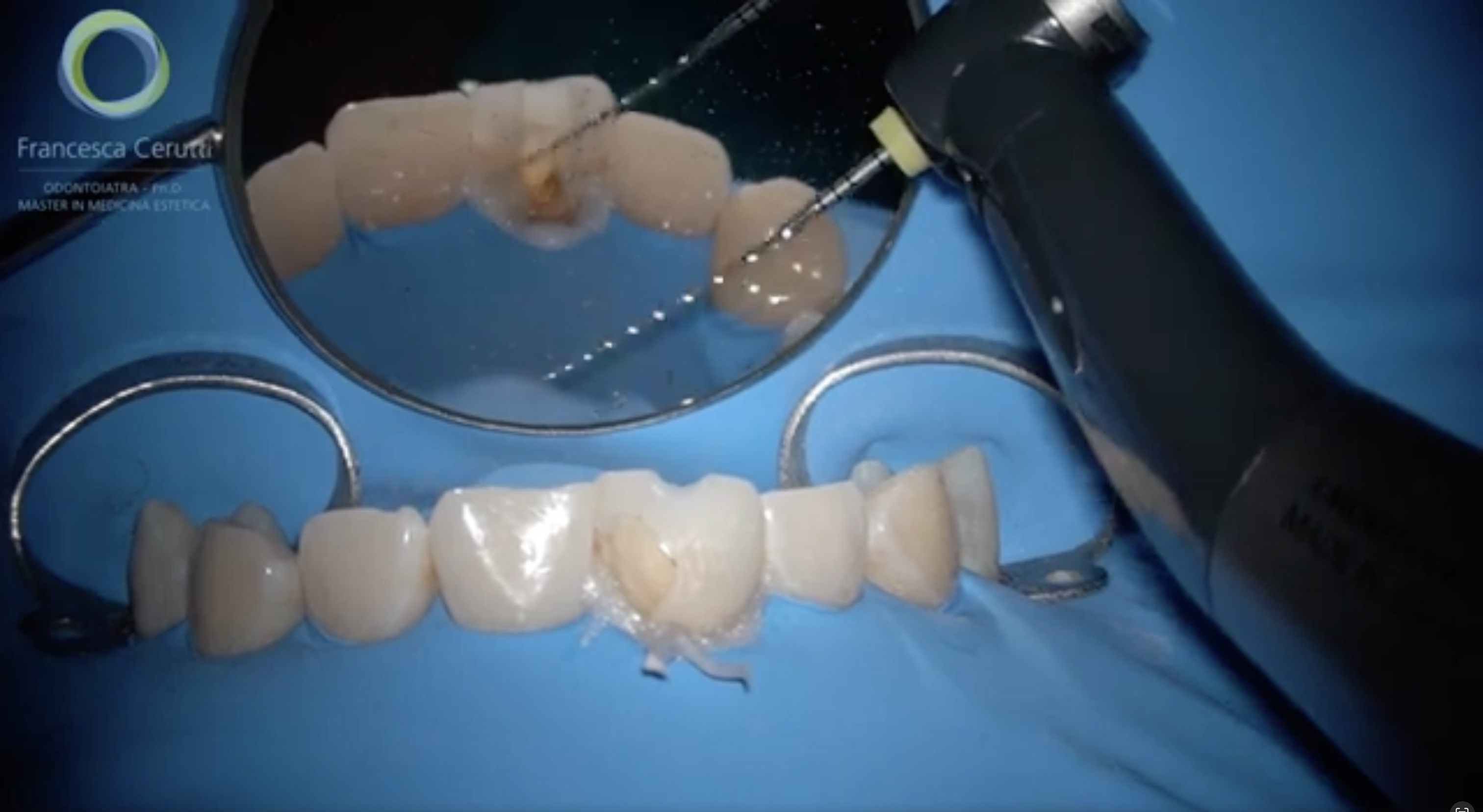 Retreatment of a central incisor with Essential Kit