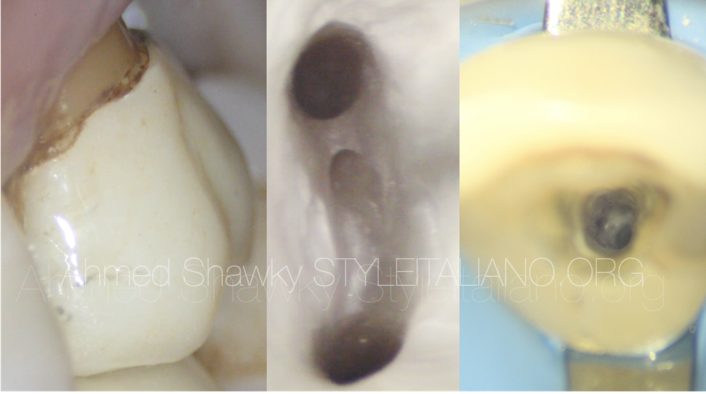 <strong>Magnification in Modern Endodontics</strong>