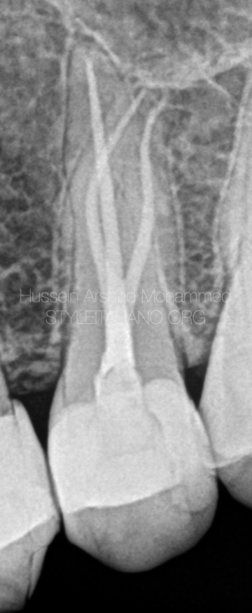 Management of molarized premolar with severly calcified and curved canals