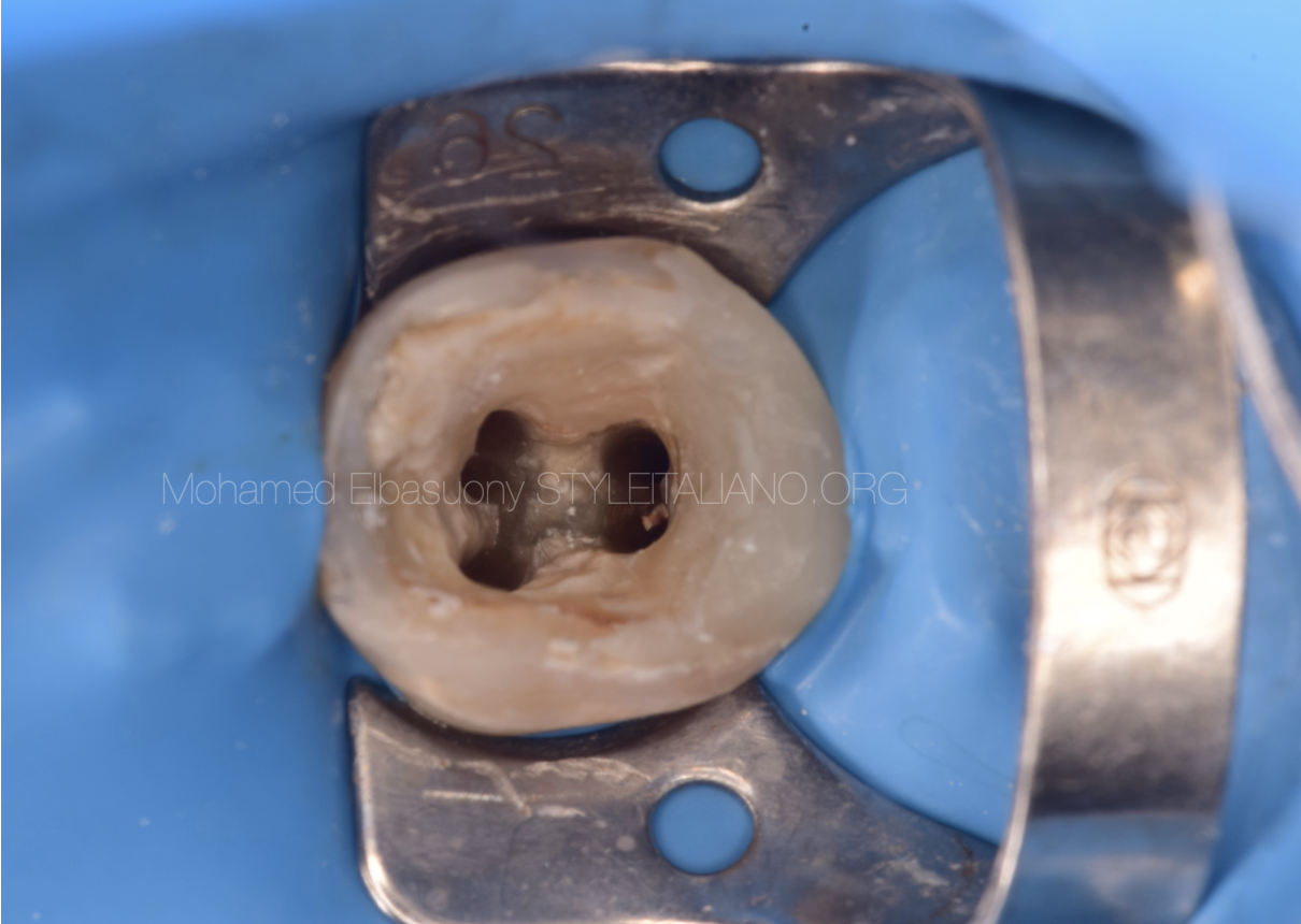 Endodontic retreatment of a mandibular first molar with missing Mid-Mesial canal