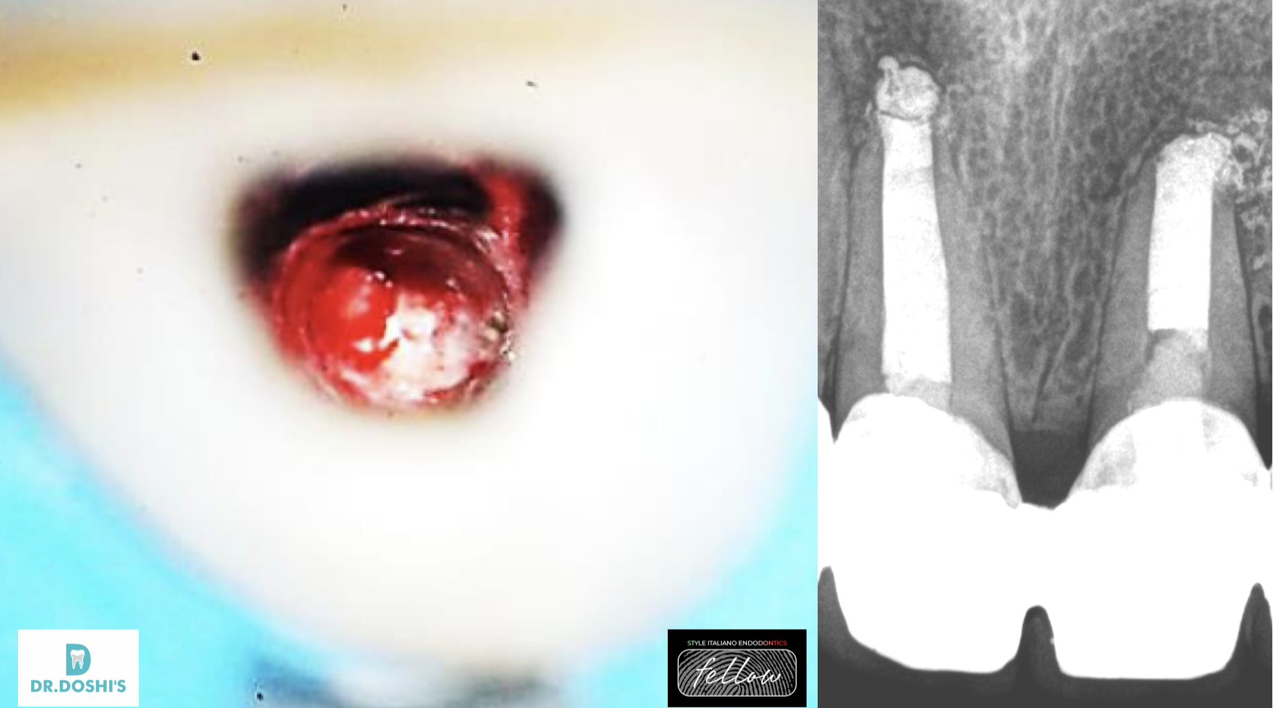 Management of Immature Permanent Incisors with wide open apex