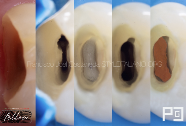 Pre-endodontic build up of an upper second premolar