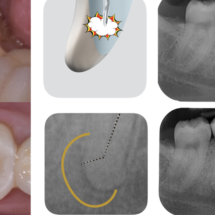 How To Manage A Ledge - A case report - Style Italiano Endodontics