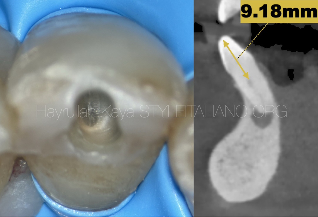 Management of Mandibular Incisor Tooth With Calcified Root Canal Anatomy