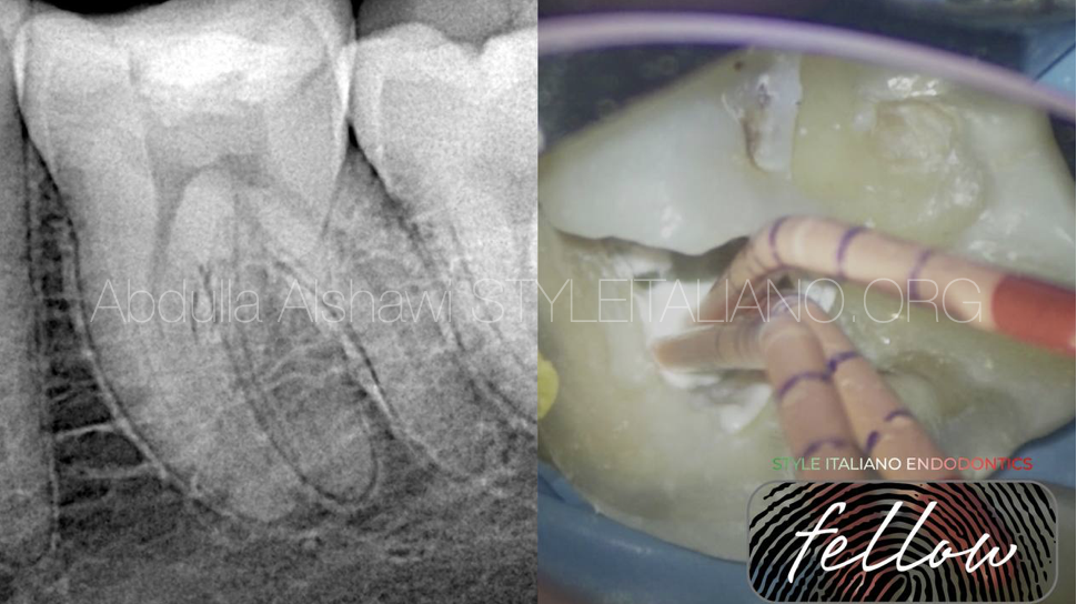 Dealing with MM canal in a lower first molar