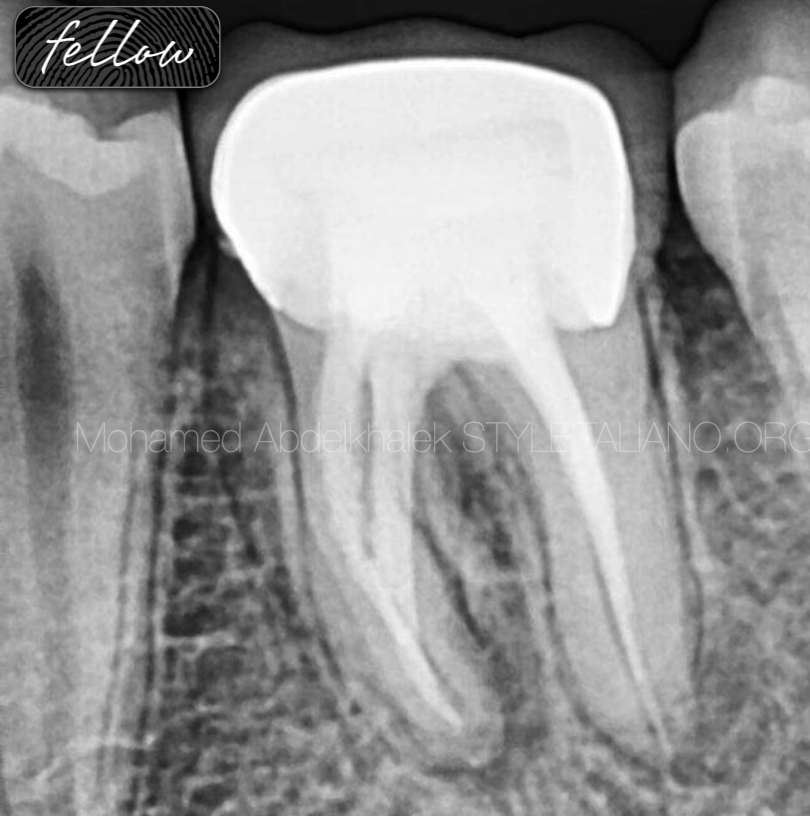 Non surgical retreatment of a lower first molar