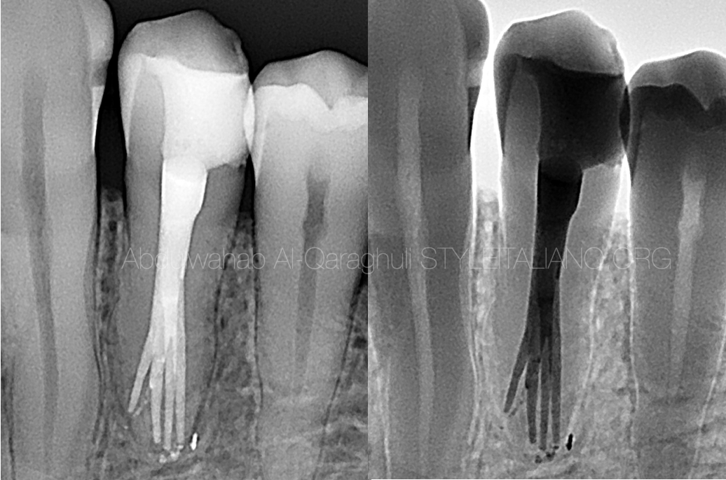The tricky lower first premolar with 4 canals