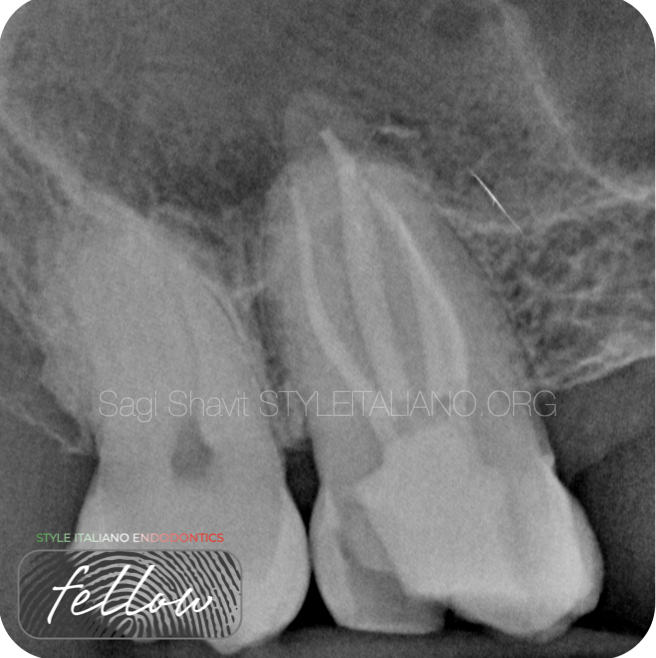 MB3 in second maxillary molar