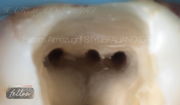 Middle mesial canal (MMC) in lower molars