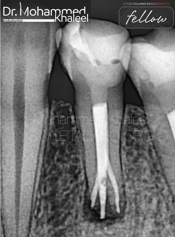Deep split in lower first premolar
