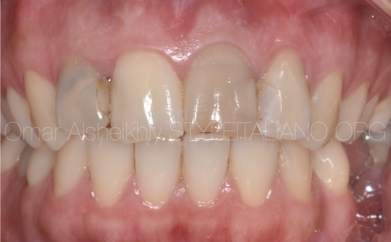MTA apical plug and internal bleaching for Upper Central Incisor