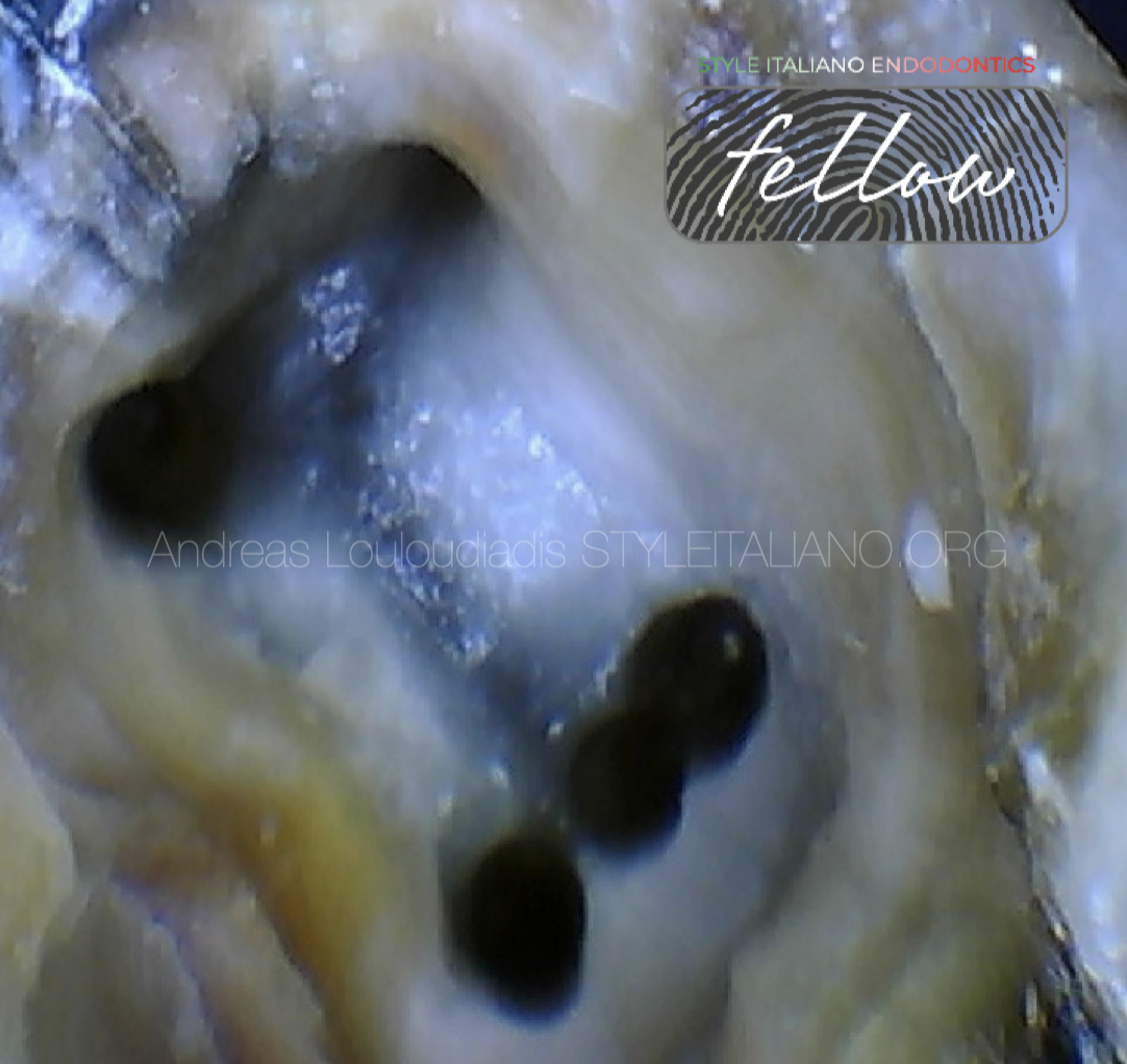 A Mandibular First Molar with Radix Entomolaris and Middle Mesial Canal: a case report