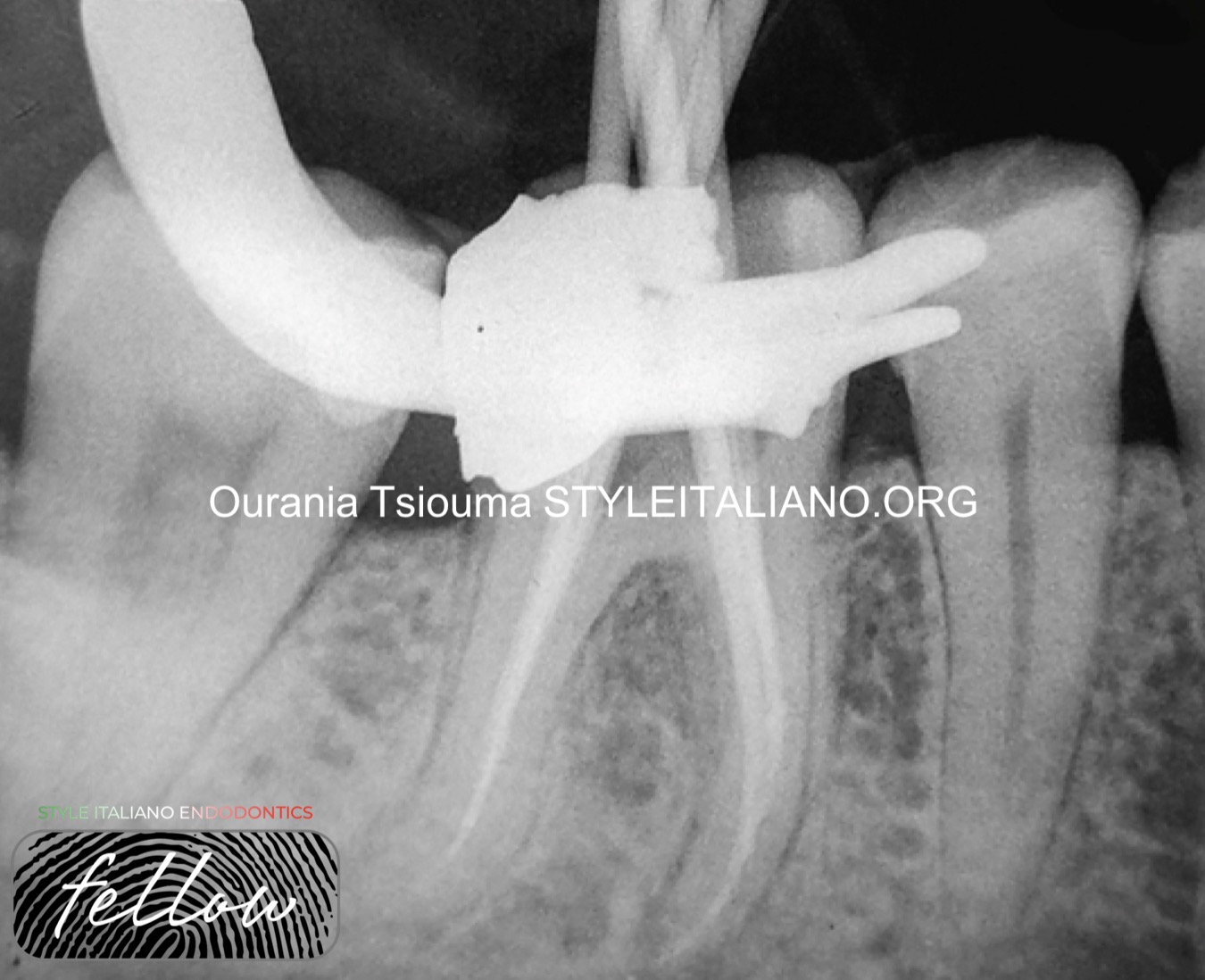 thumbnail image 2 of 36-Piece Dental Endodontic Root Canal Practice Teeth - RCT Study Model 2 of 5