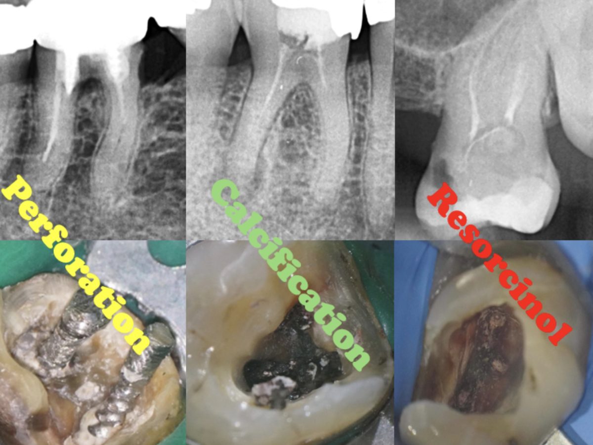 Bridging the Gap: How Today's Endodontics Overcome Past