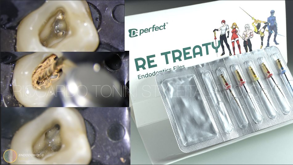 Retratment of an upper first molar made with the Retreaty kit by Perfect Endo