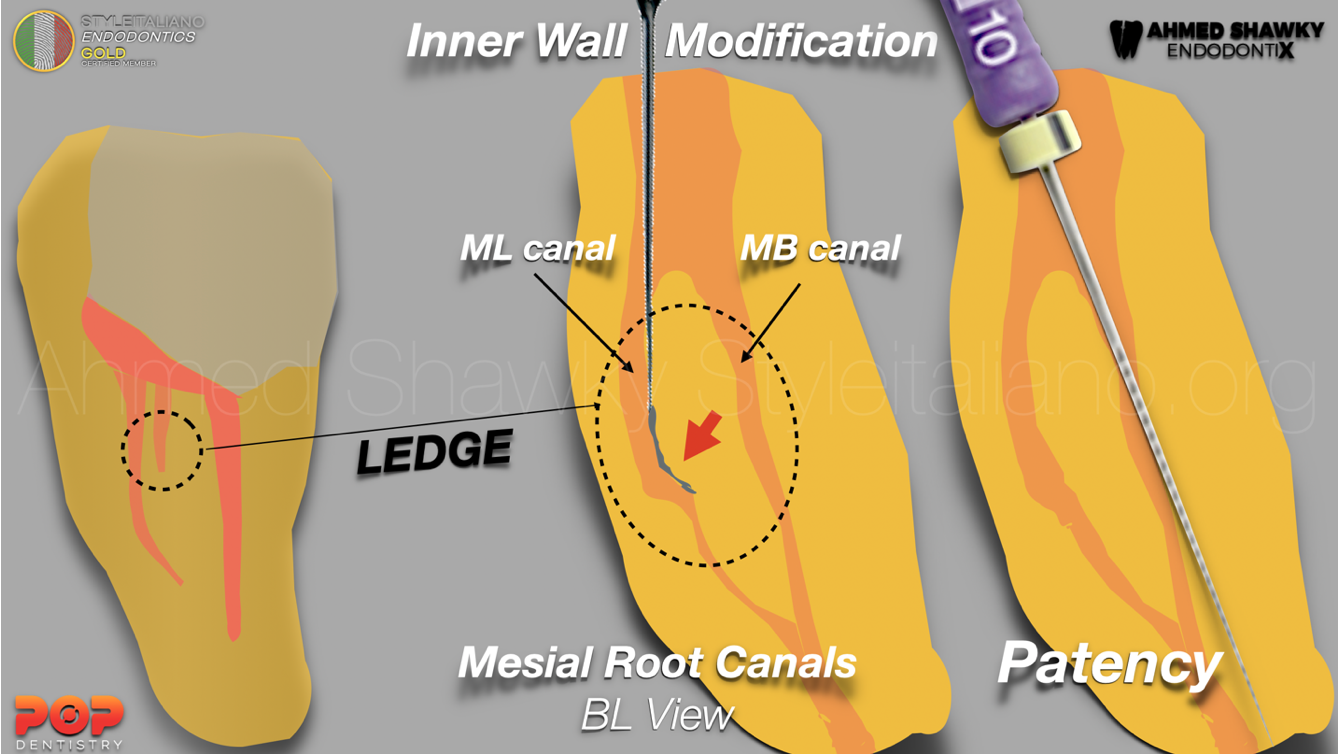 RETREATY: A Fore Player in Non-Surgical Retreatments