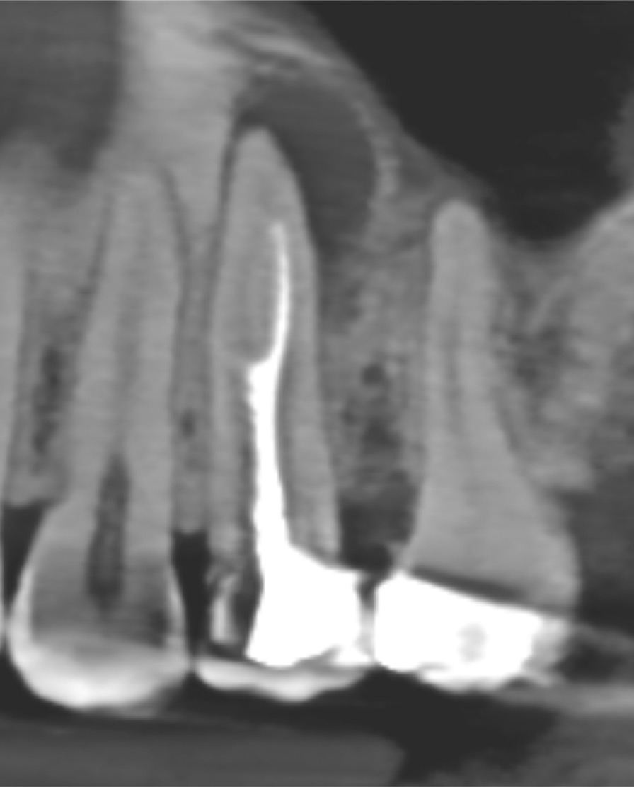 Case report of retreatment of molarized premolar