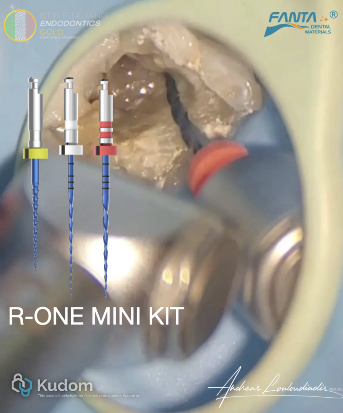 Small Kit, Big Impact: Enhancing endodontic outcome with the R-One Mini Kit  by Fanta