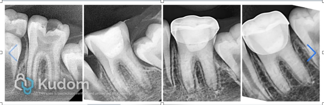 Biological Approach to Revitalization in Immature Permanent Teeth: No-instrumentation Technique
