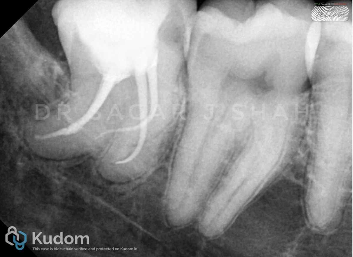 THE CURVE CONUNDRUM: ENDODONTIC MANAGEMENT OF A DILACERATED THIRD
