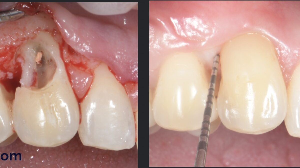 乳頭再建 = Papilla reconstruction Single-stage crown lengthening and papilla reconstruction with a