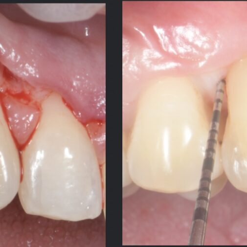 Single-stage crown lengthening and papilla reconstruction with a